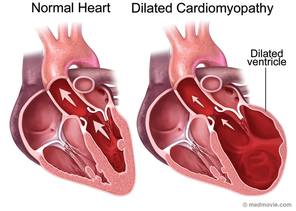 Дилатационная кардиомиопатия причины