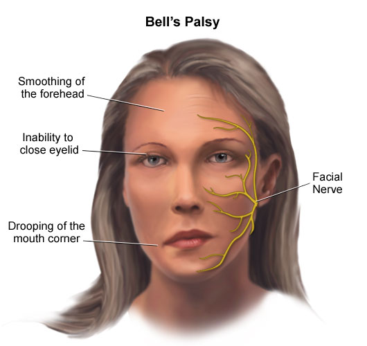 невропатия лицевого нерва лечение