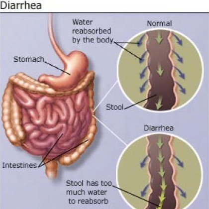 Лечение диареи