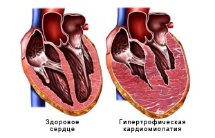 Рестриктивная кардиомиопатия